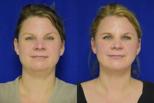 Rhinoplasty, Chin Implant, Liposuction before and after photo by Dr. Sean Weiss in Metairie, LA