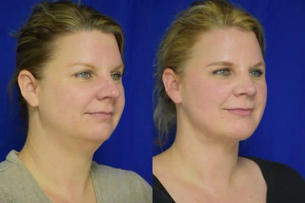 Rhinoplasty, Chin Implant, Liposuction before and after photo by Dr. Sean Weiss in Metairie, LA