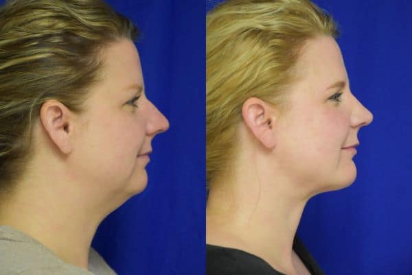 Rhinoplasty, Chin Implant, Liposuction before and after photo by Dr. Sean Weiss in Metairie, LA