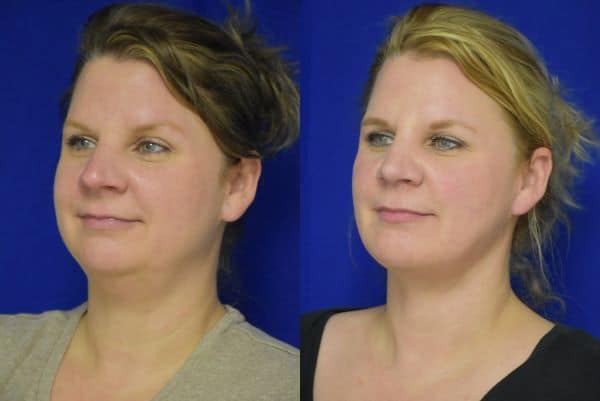 Rhinoplasty, Chin Implant, Liposuction before and after photo by Dr. Sean Weiss in Metairie, LA