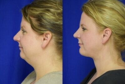 Rhinoplasty before and after photo by Dr. Sean Weiss in Metairie, LA