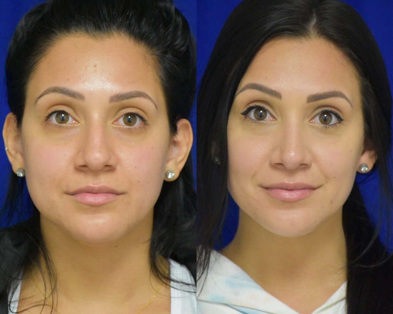 Rhinoplasty before and after photo by Dr. Sean Weiss in Metairie, LA