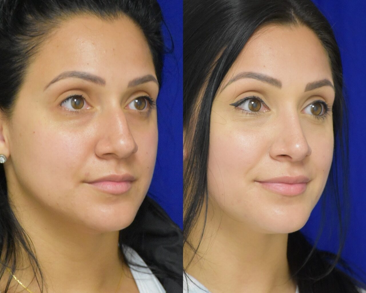 Rhinoplasty before and after photo by Dr. Sean Weiss in Metairie, LA