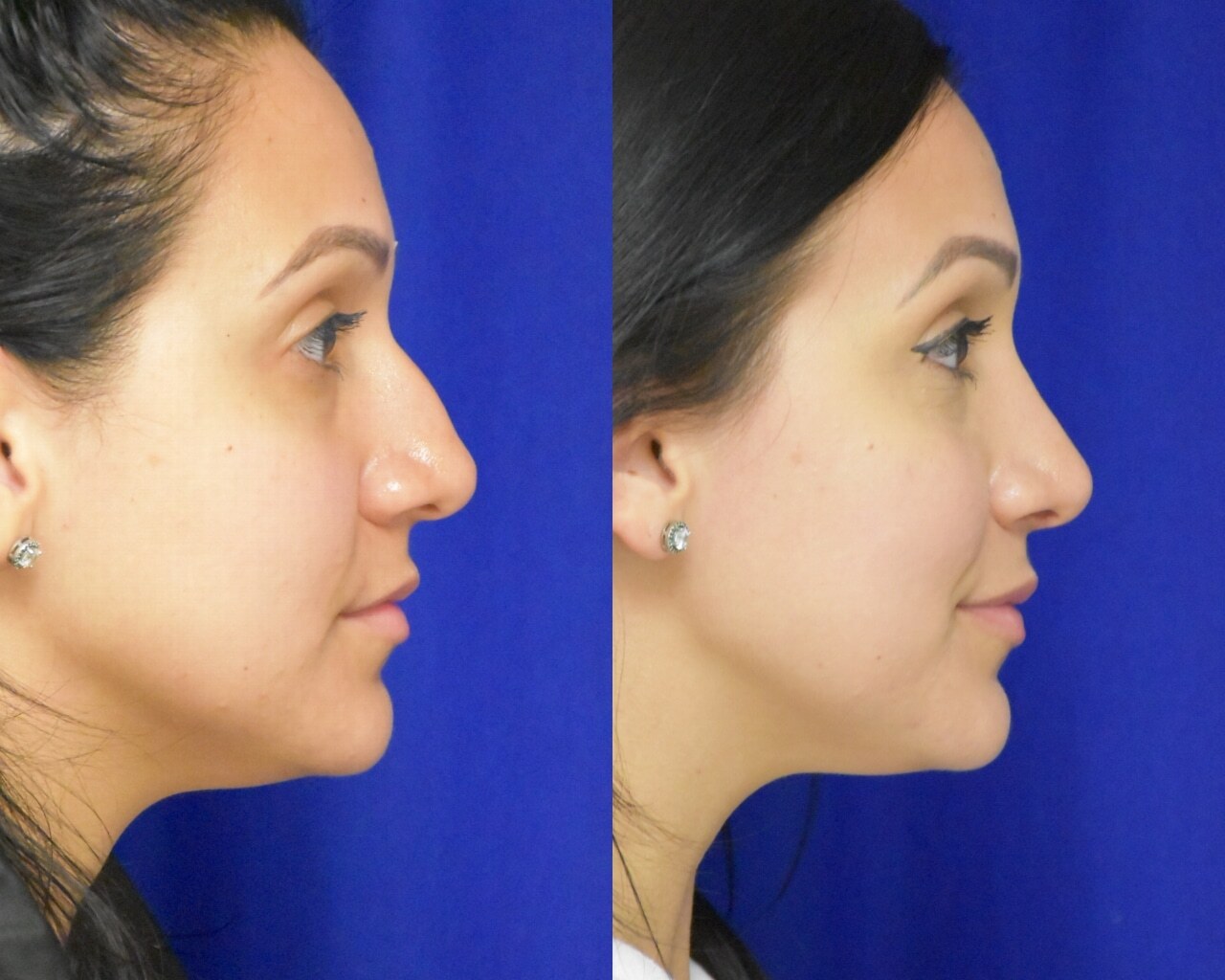 Rhinoplasty before and after photo by Dr. Sean Weiss in Metairie, LA