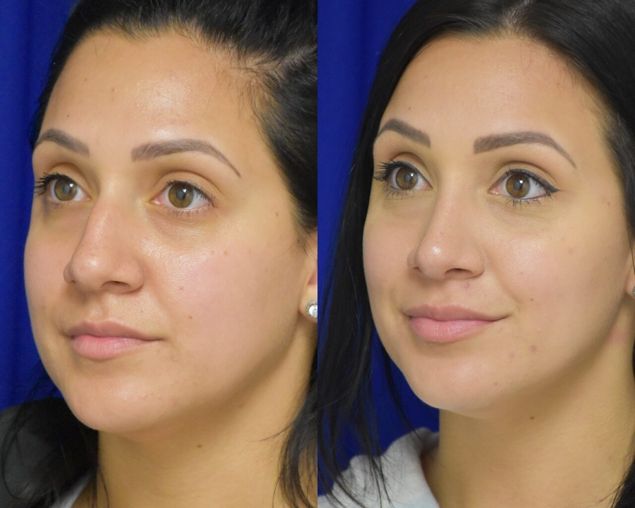 Rhinoplasty before and after photo by Dr. Sean Weiss in Metairie, LA