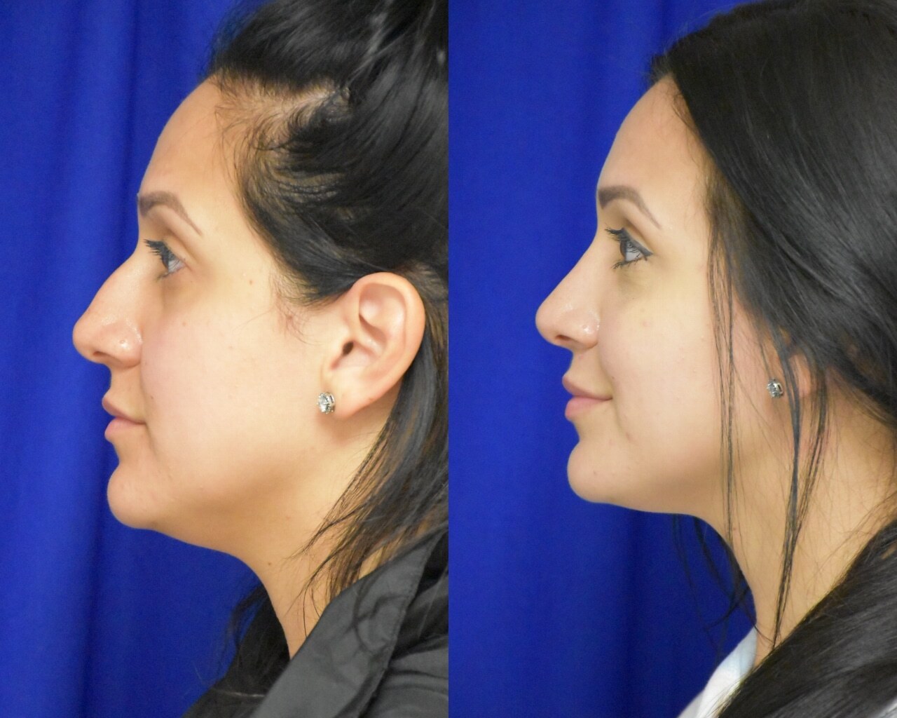 Rhinoplasty before and after photo by Dr. Sean Weiss in Metairie, LA