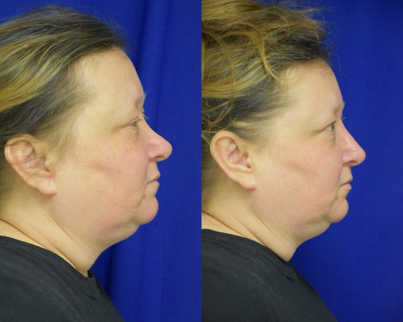 Liquid Rhinoplasty before and after photo by Dr. Sean Weiss in Metairie, LA