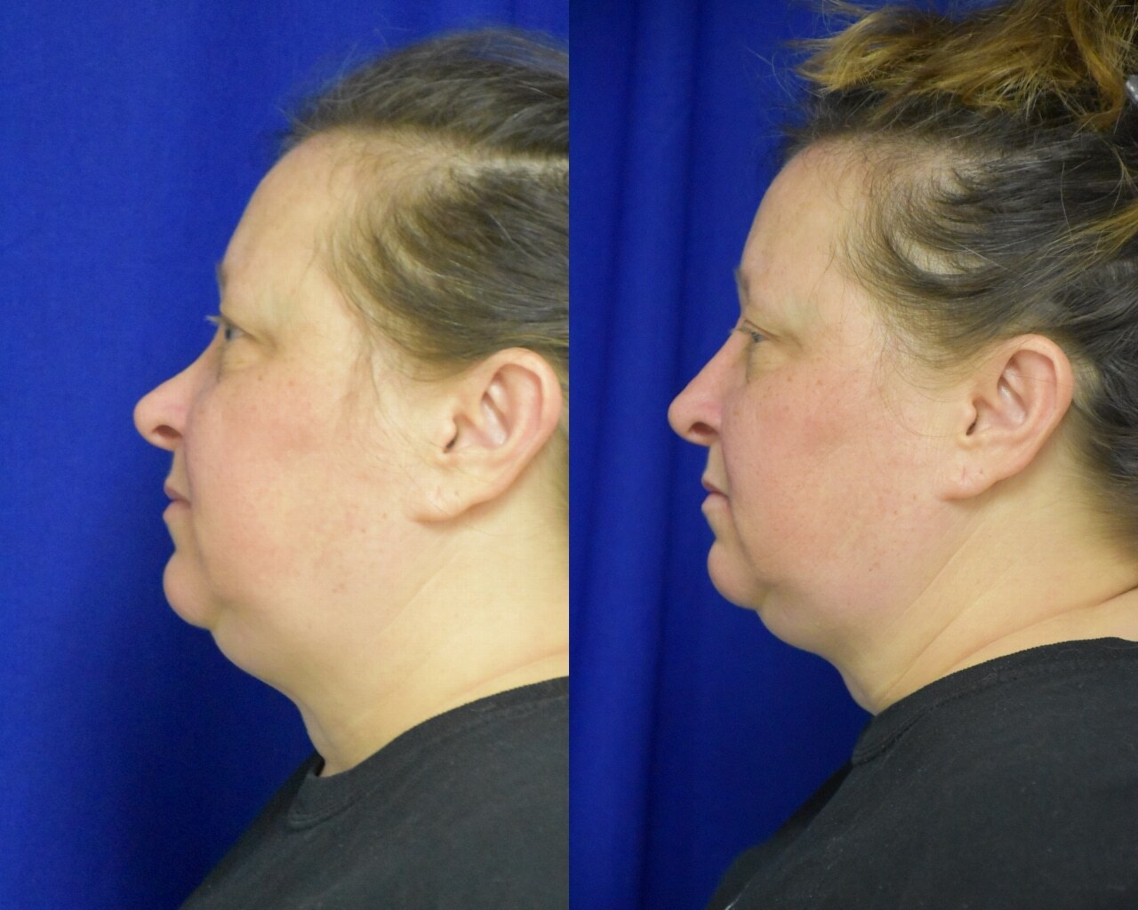 Liquid Rhinoplasty before and after photo by Dr. Sean Weiss in Metairie, LA