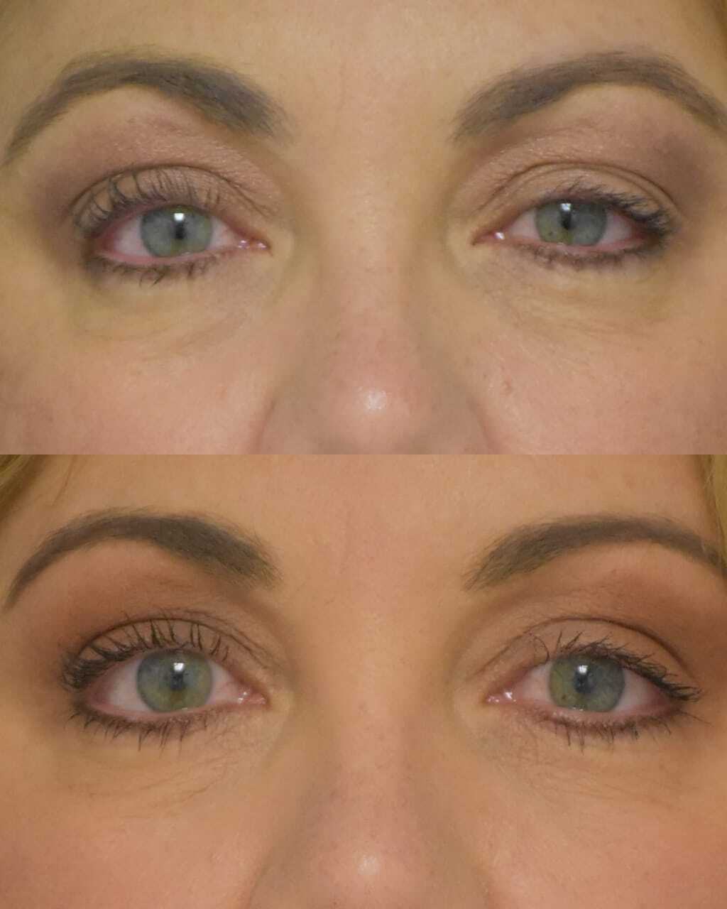 Blepharoplasty before and after photo by Dr. Sean Weiss in Metairie, LA