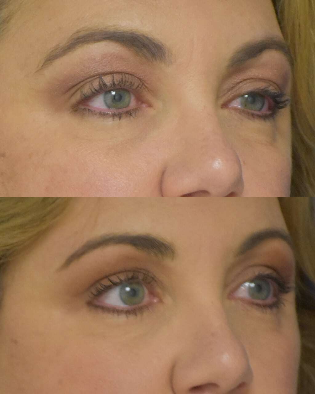 Blepharoplasty before and after photo by Dr. Sean Weiss in Metairie, LA