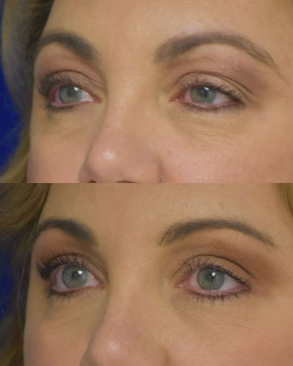 Blepharoplasty before and after photo by Dr. Sean Weiss in Metairie, LA