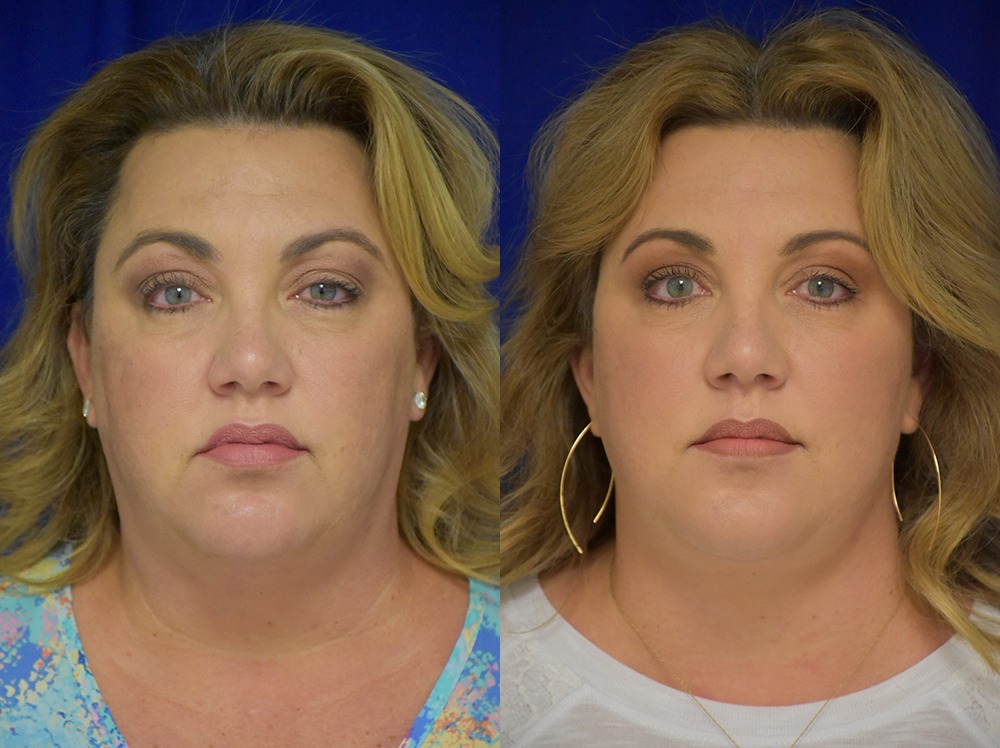 Blepharoplasty before and after photo by Dr. Sean Weiss in Metairie LA