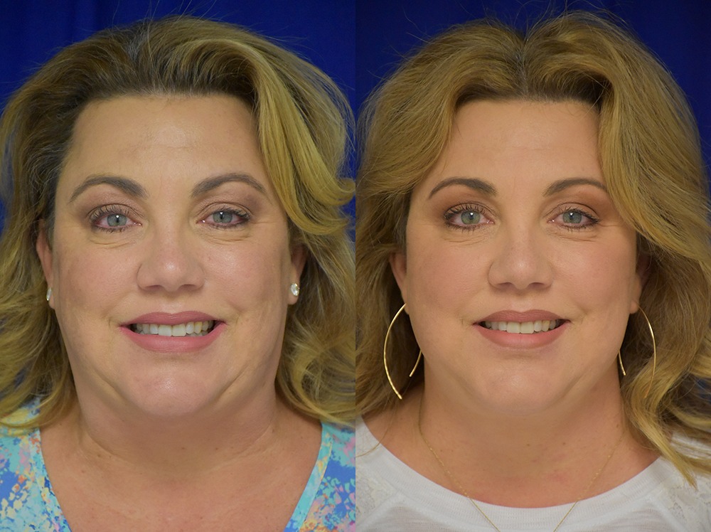 Blepharoplasty before and after photo by Dr. Sean Weiss in Metairie LA