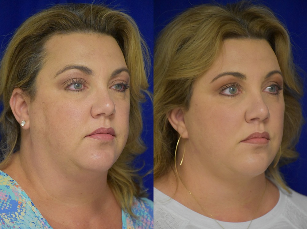 Blepharoplasty before and after photo by Dr. Sean Weiss in Metairie LA