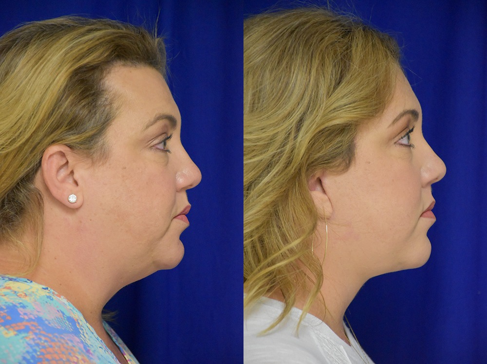 Blepharoplasty before and after photo by Dr. Sean Weiss in Metairie LA