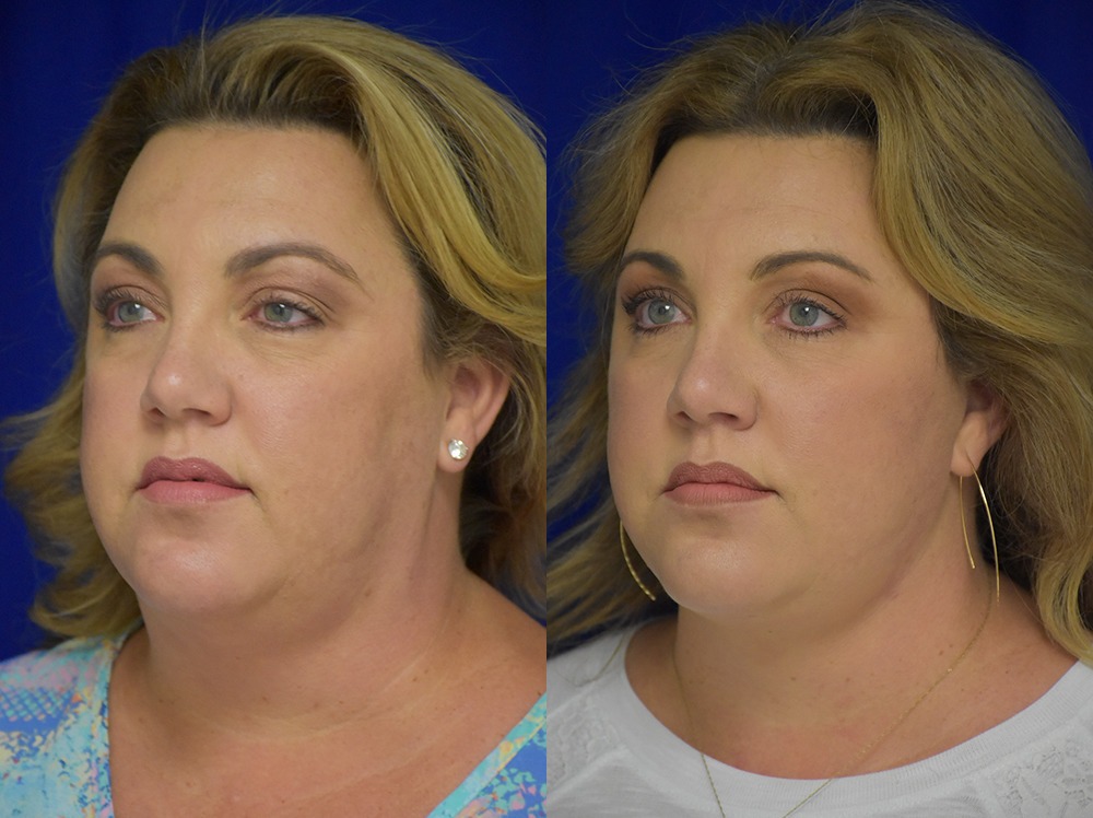 Blepharoplasty before and after photo by Dr. Sean Weiss in Metairie LA