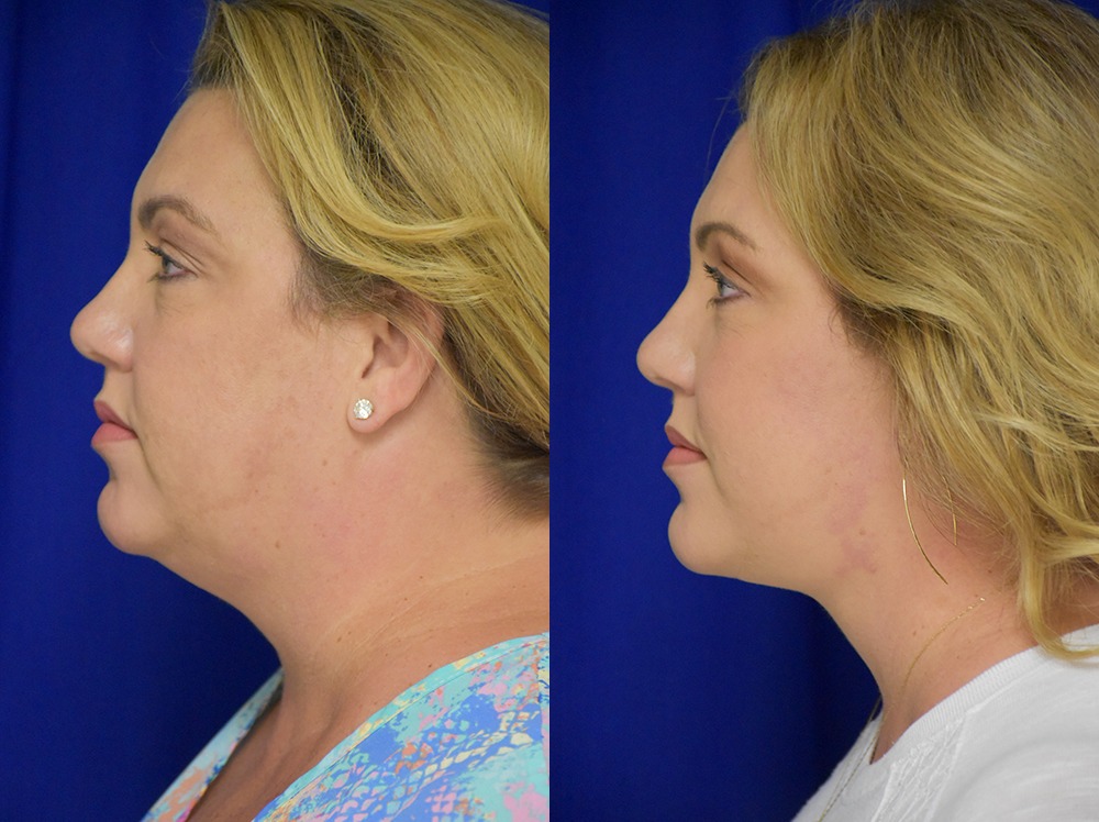 Blepharoplasty before and after photo by Dr. Sean Weiss in Metairie LA