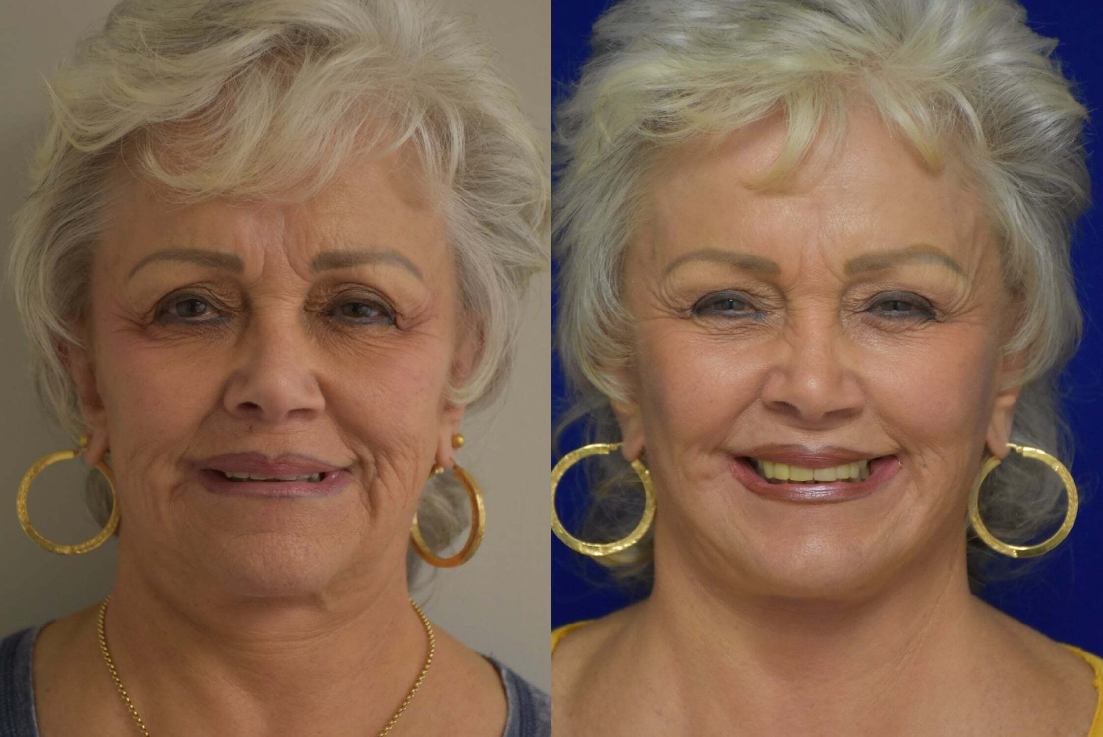 Facelift before and after photo by Dr. Sean Weiss in Metairie, LA