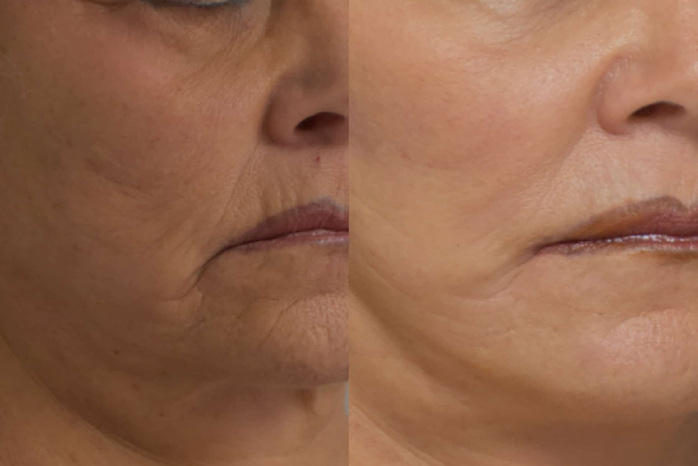 Facelift before and after photo by Dr. Sean Weiss in Metairie, LA