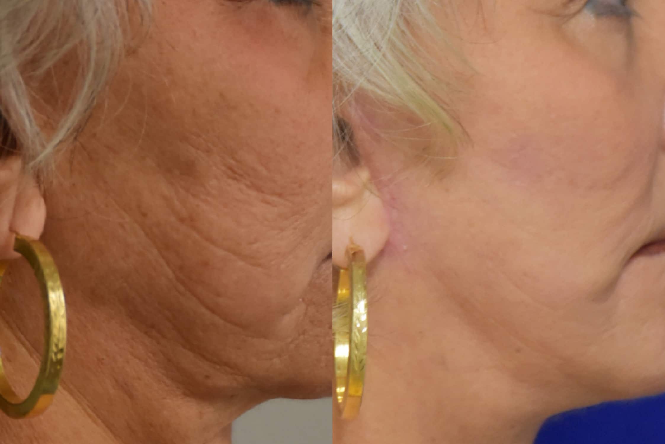 Facelift before and after photo by Dr. Sean Weiss in Metairie, LA