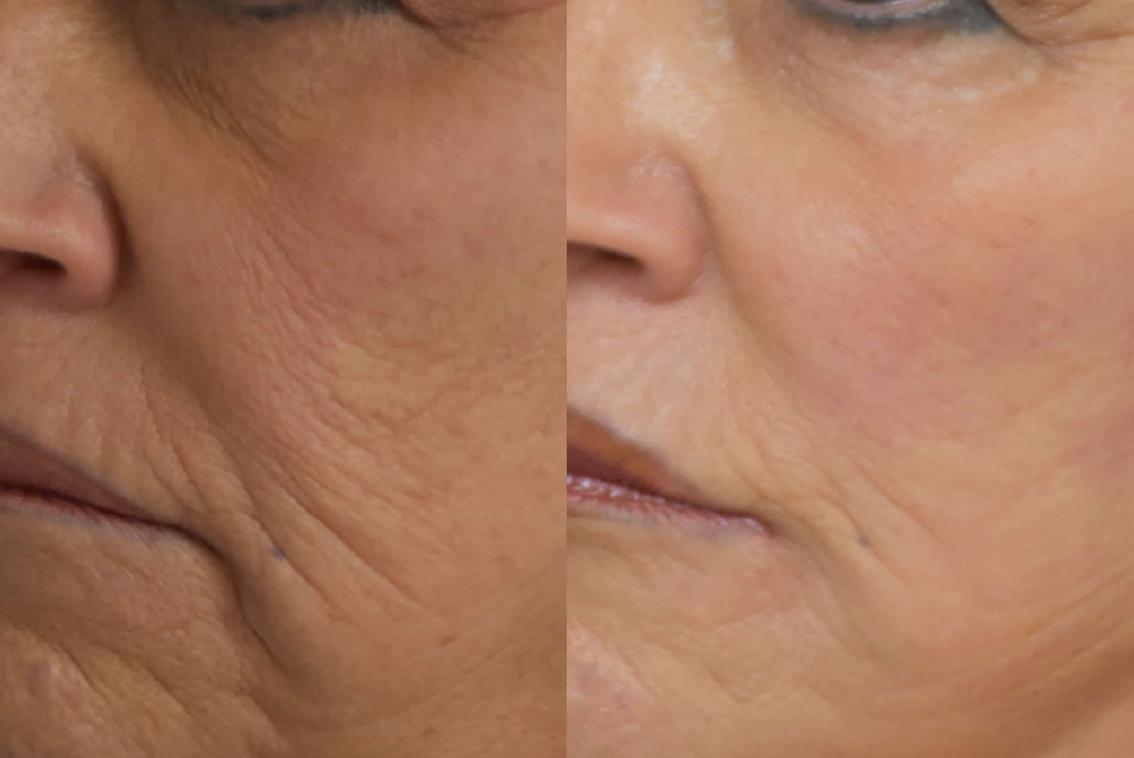 Facelift before and after photo by Dr. Sean Weiss in Metairie, LA