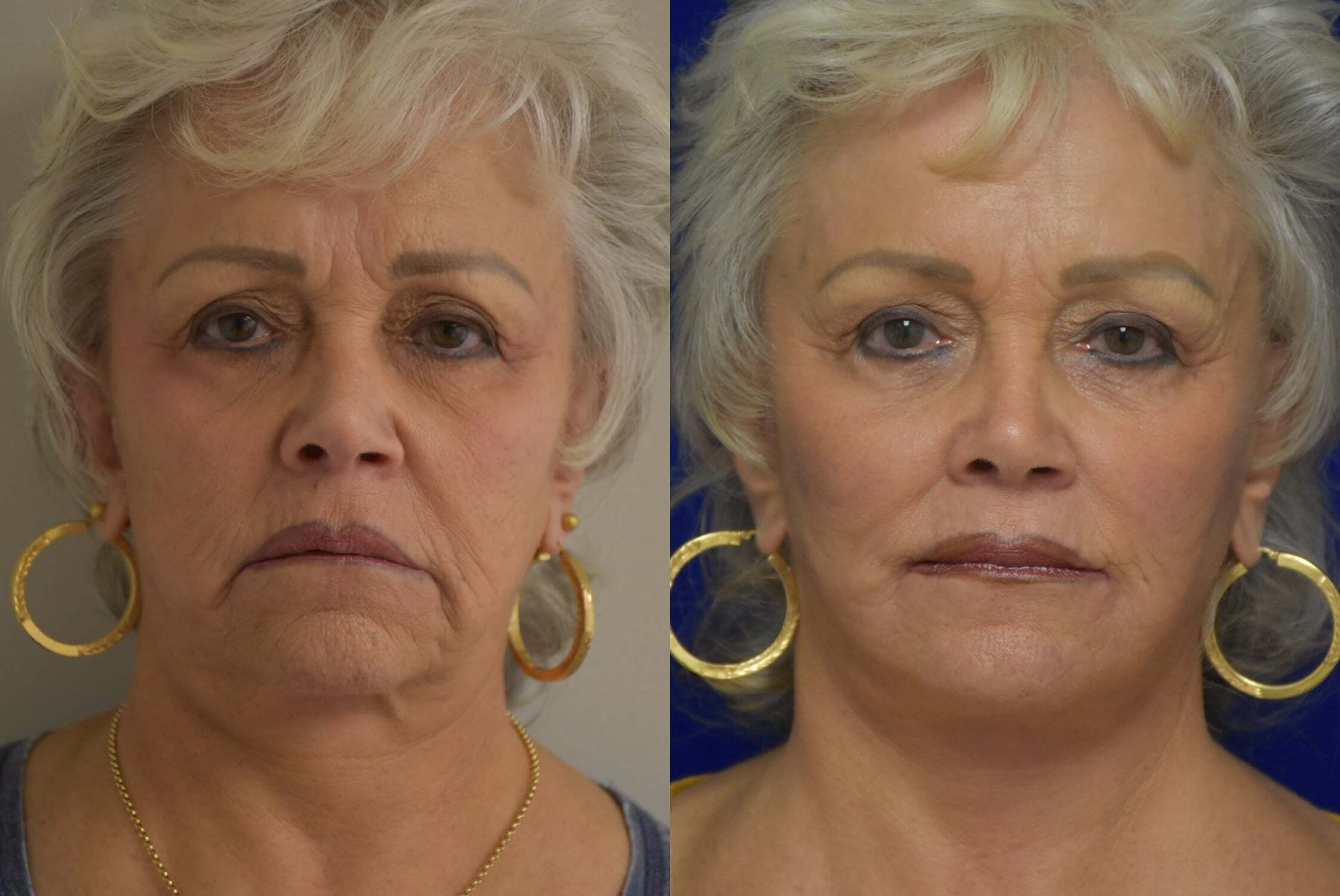 Facelift before and after photo by Dr. Sean Weiss in Metairie, LA