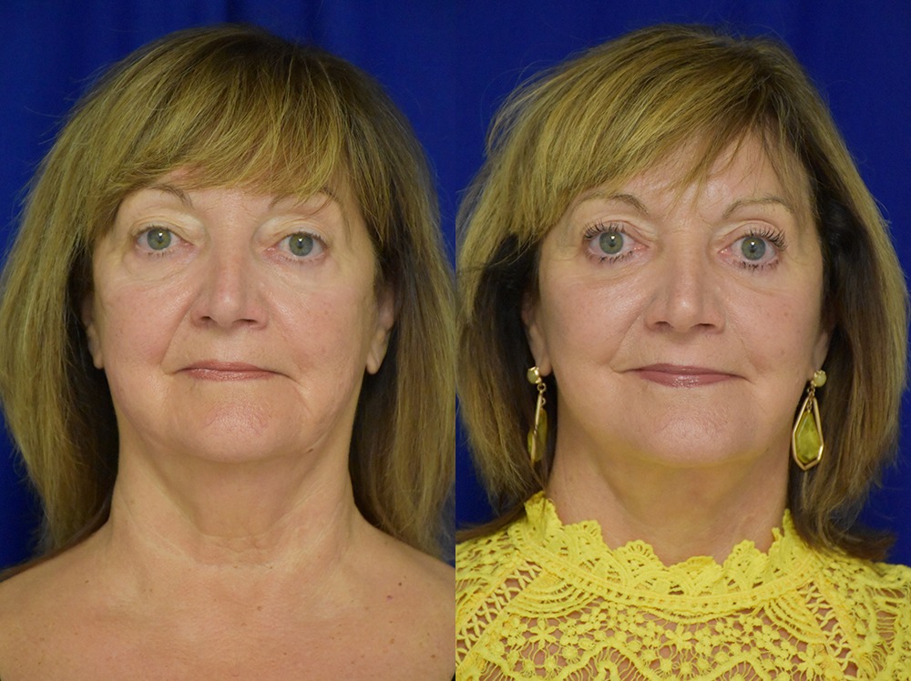 Blepharoplasty before and after photo by Dr. Sean Weiss in Metairie LA