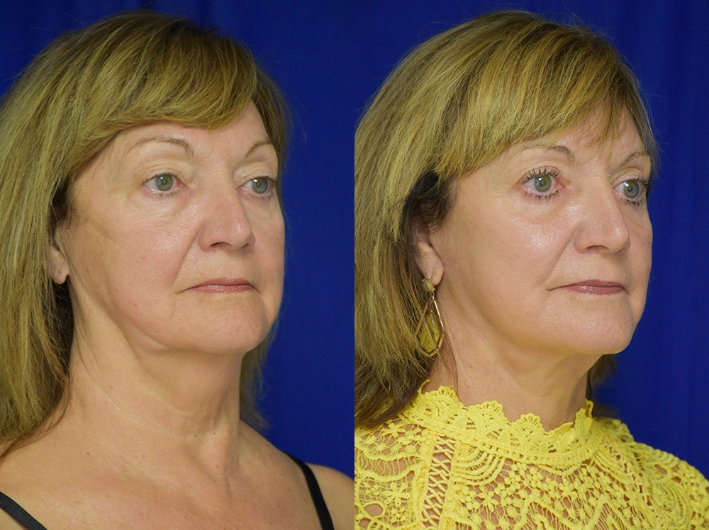 Blepharoplasty before and after photo by Dr. Sean Weiss in Metairie LA