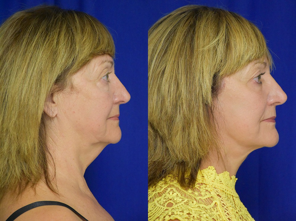 Blepharoplasty before and after photo by Dr. Sean Weiss in Metairie LA