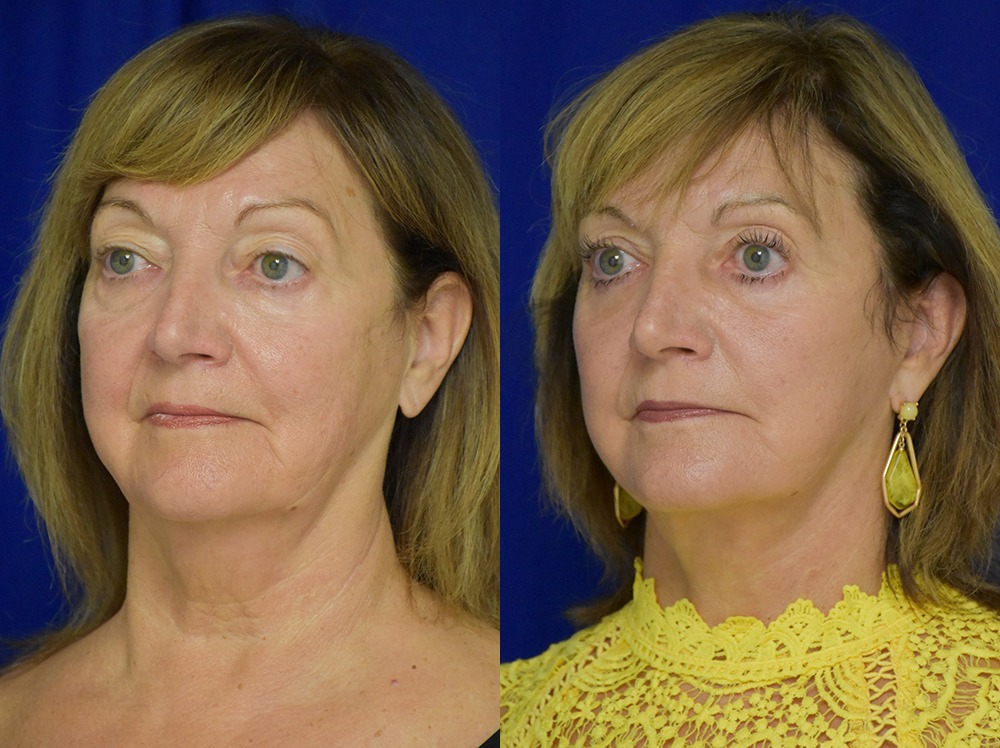 Blepharoplasty before and after photo by Dr. Sean Weiss in Metairie LA