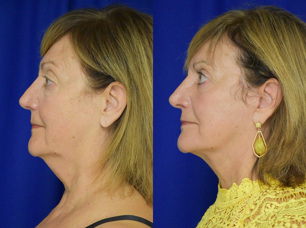 Blepharoplasty before and after photo by Dr. Sean Weiss in Metairie LA