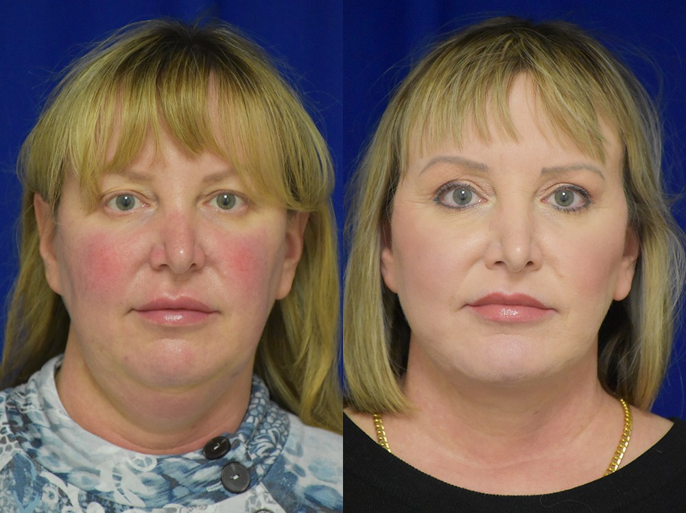 Blepharoplasty before and after photo by Dr. Sean Weiss in Metairie LA