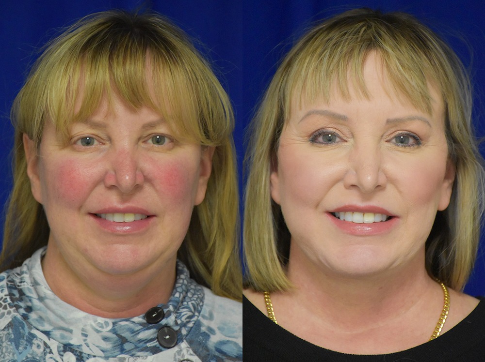 Blepharoplasty before and after photo by Dr. Sean Weiss in Metairie LA