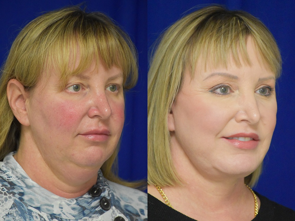 Blepharoplasty before and after photo by Dr. Sean Weiss in Metairie LA