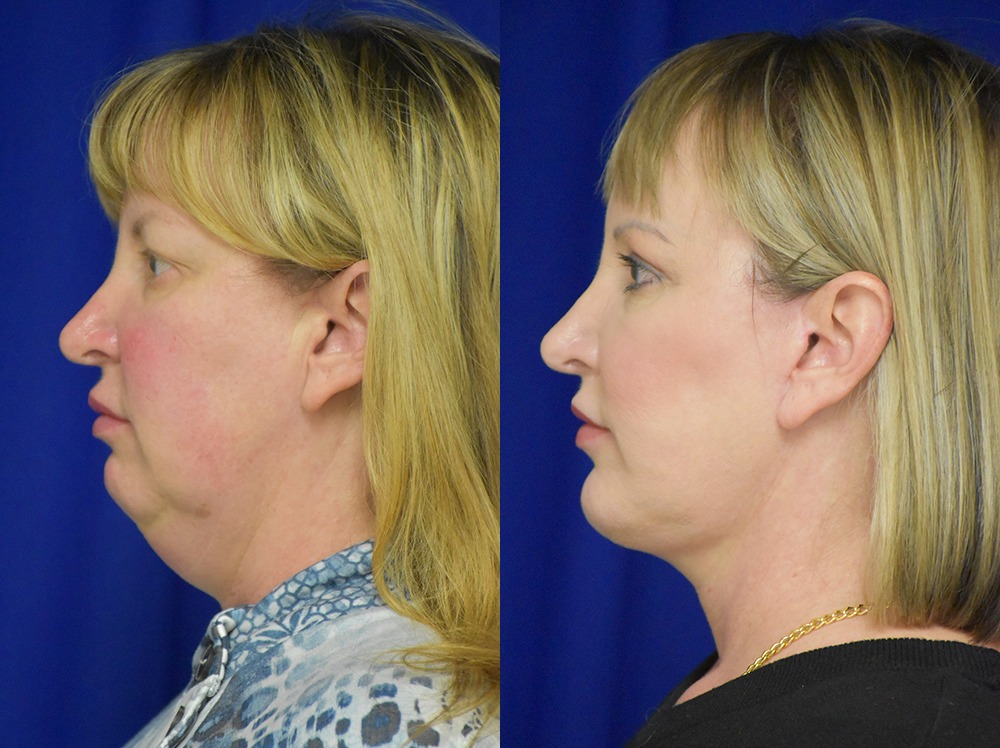 Blepharoplasty before and after photo by Dr. Sean Weiss in Metairie LA