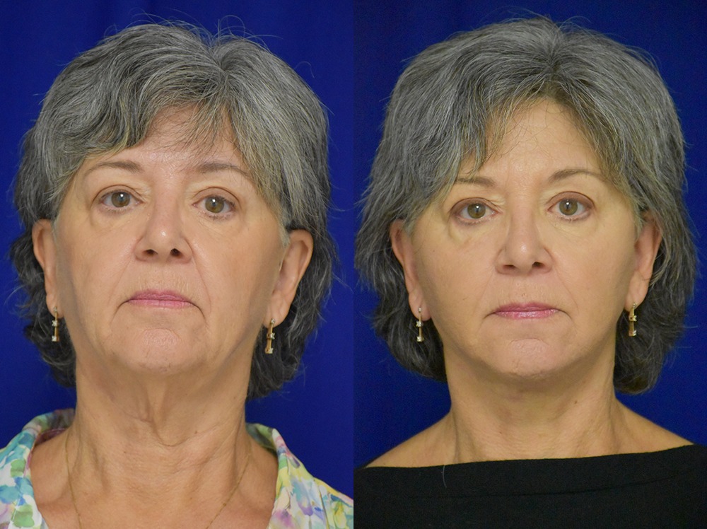 Facelift before and after photo by Dr. Sean Weiss in Metairie LA