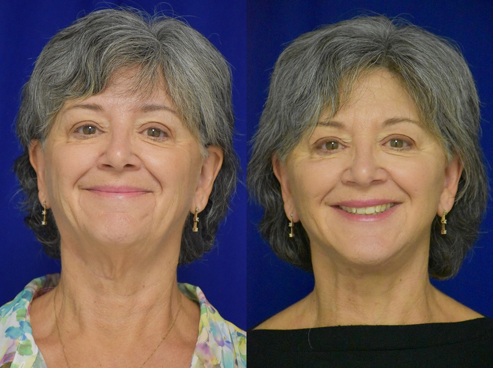 Facelift before and after photo by Dr. Sean Weiss in Metairie LA