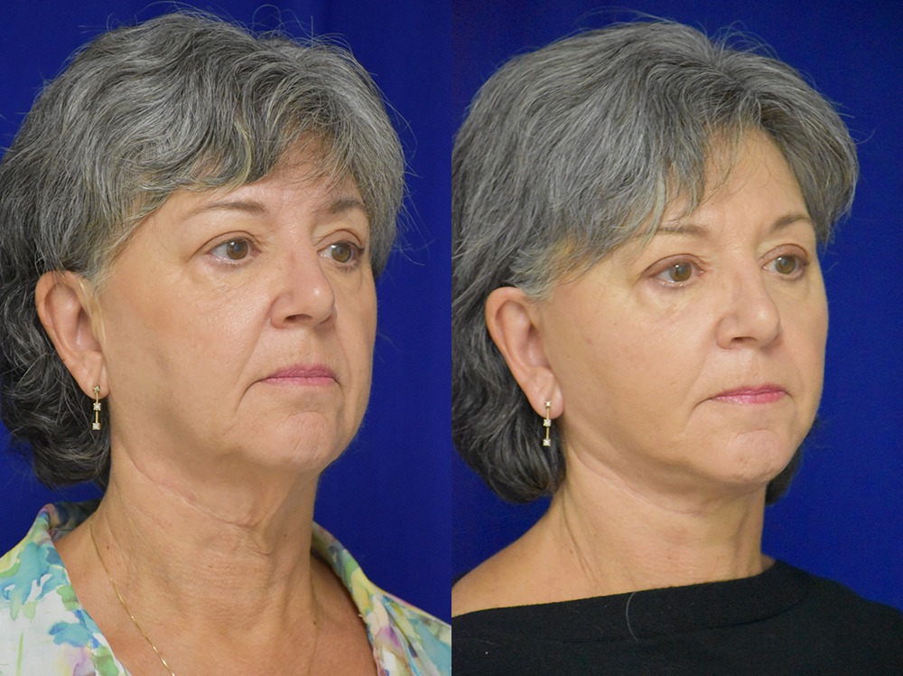 Facelift before and after photo by Dr. Sean Weiss in Metairie LA