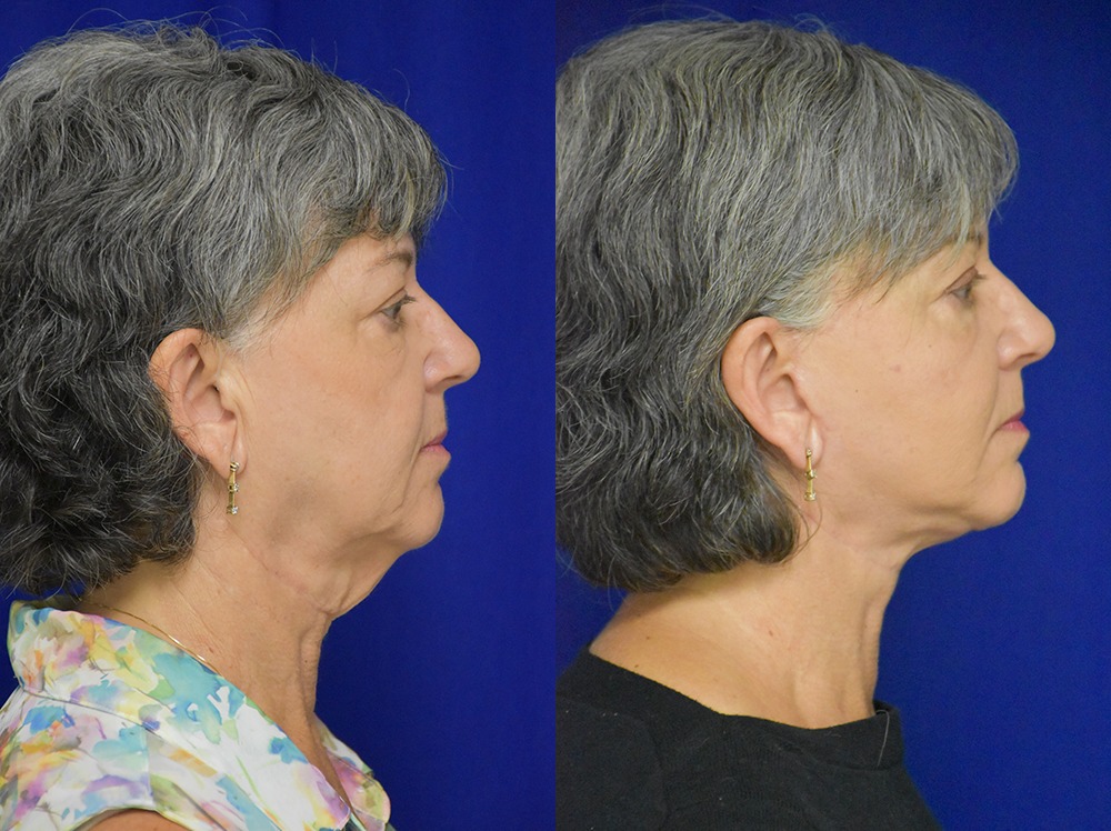 Facelift before and after photo by Dr. Sean Weiss in Metairie LA