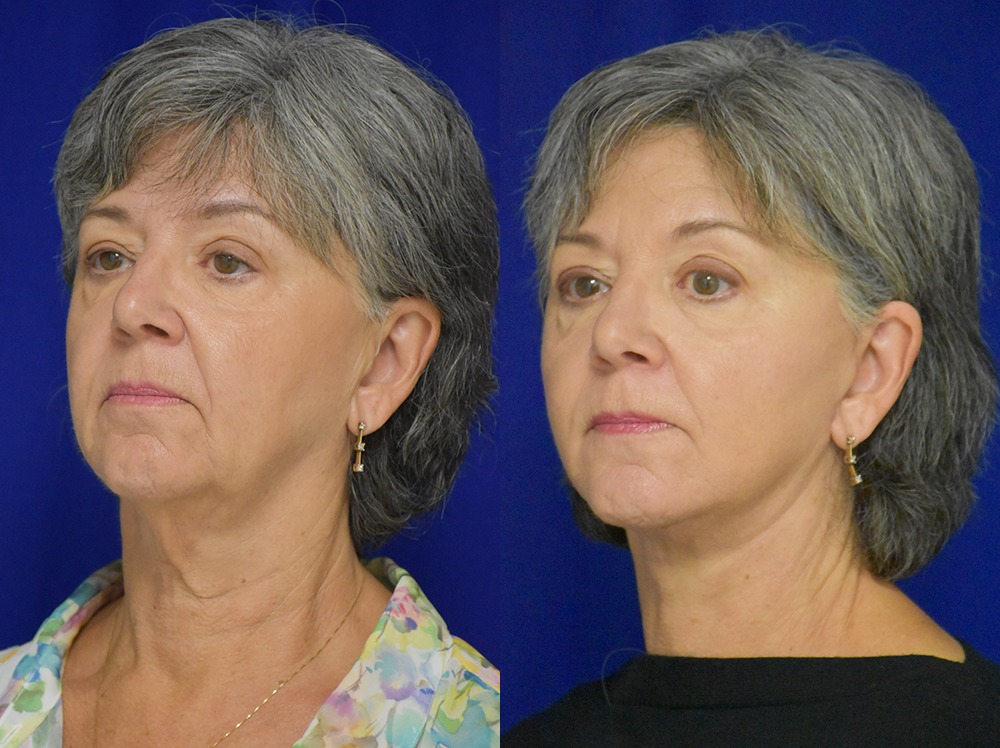 Facelift before and after photo by Dr. Sean Weiss in Metairie LA