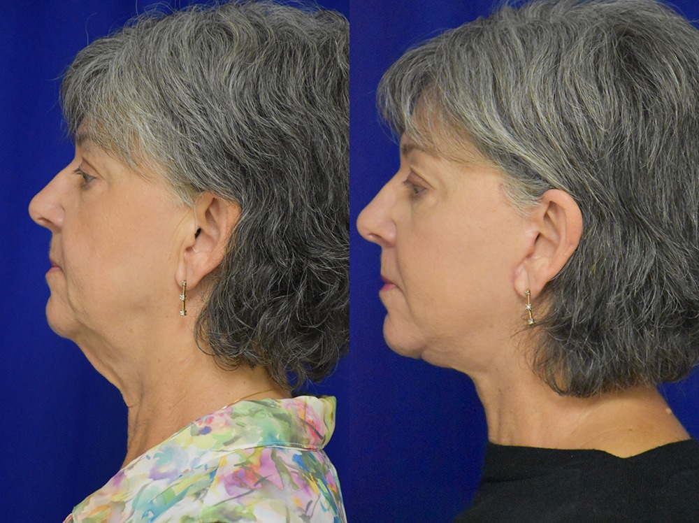 Facelift before and after photo by Dr. Sean Weiss in Metairie LA