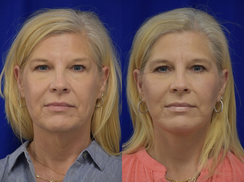 Blepharoplasty before and after photo by Dr. Sean Weiss in Metairie LA