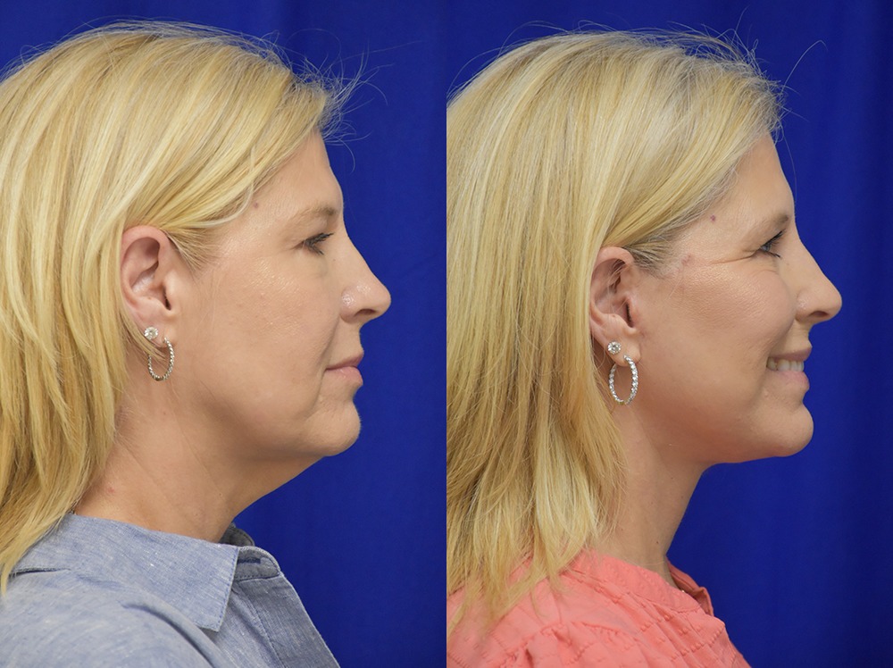 Blepharoplasty before and after photo by Dr. Sean Weiss in Metairie LA