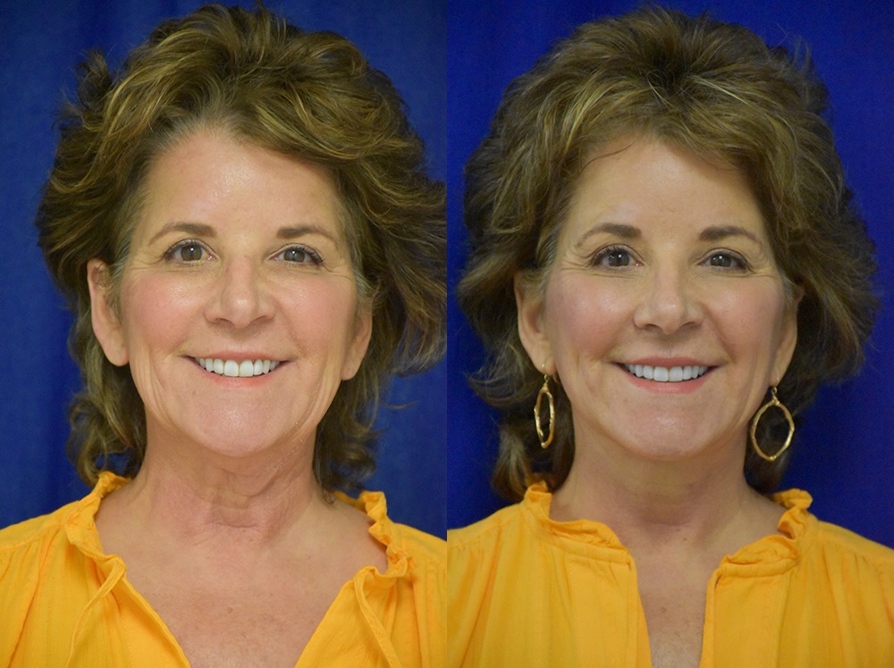 Facelift before and after photo by Dr. Sean Weiss in Metairie LA