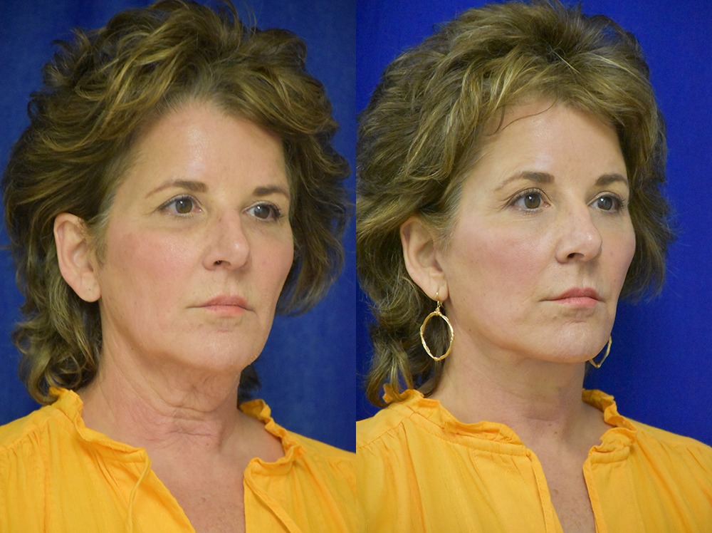 Facelift before and after photo by Dr. Sean Weiss in Metairie LA