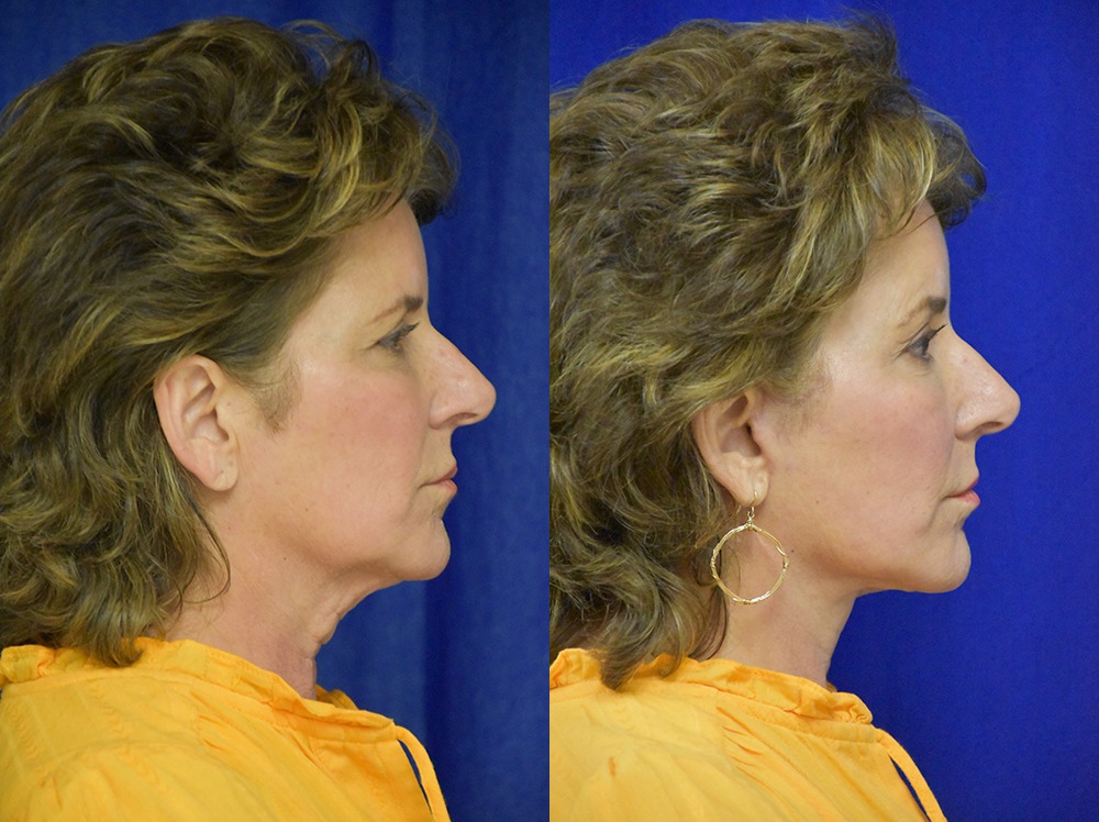 Facelift before and after photo by Dr. Sean Weiss in Metairie LA