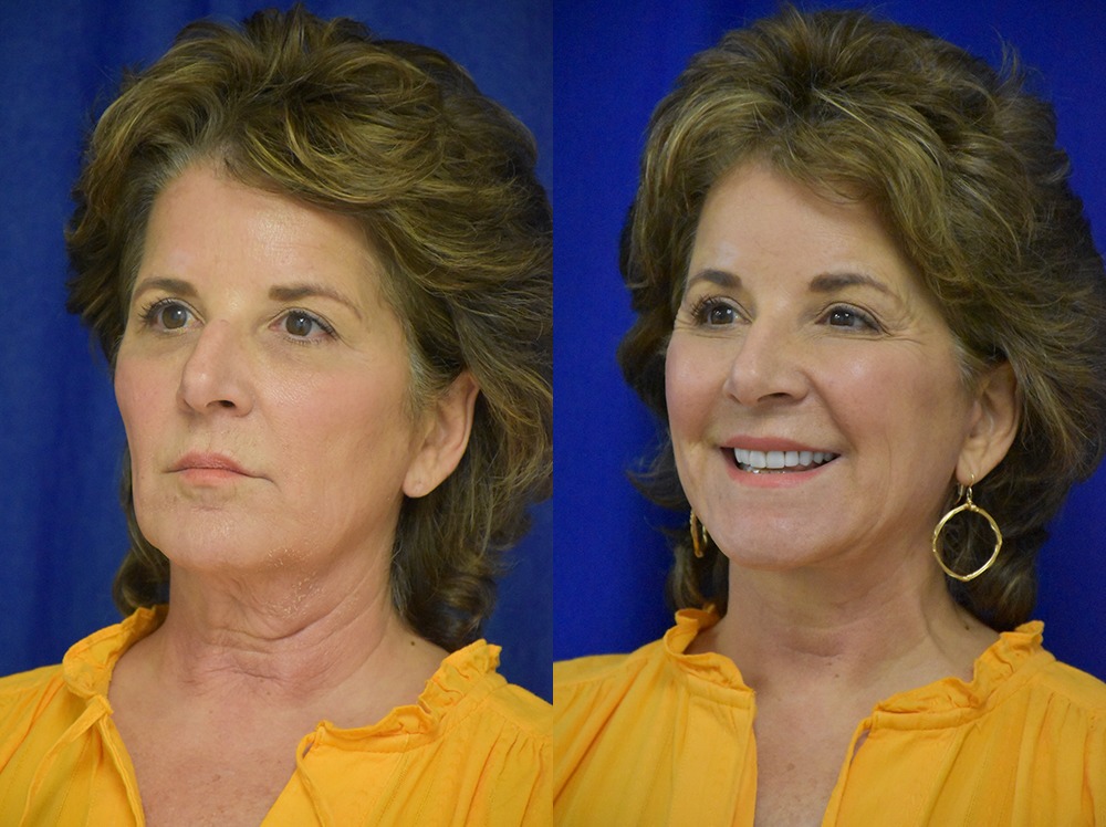 Facelift before and after photo by Dr. Sean Weiss in Metairie LA