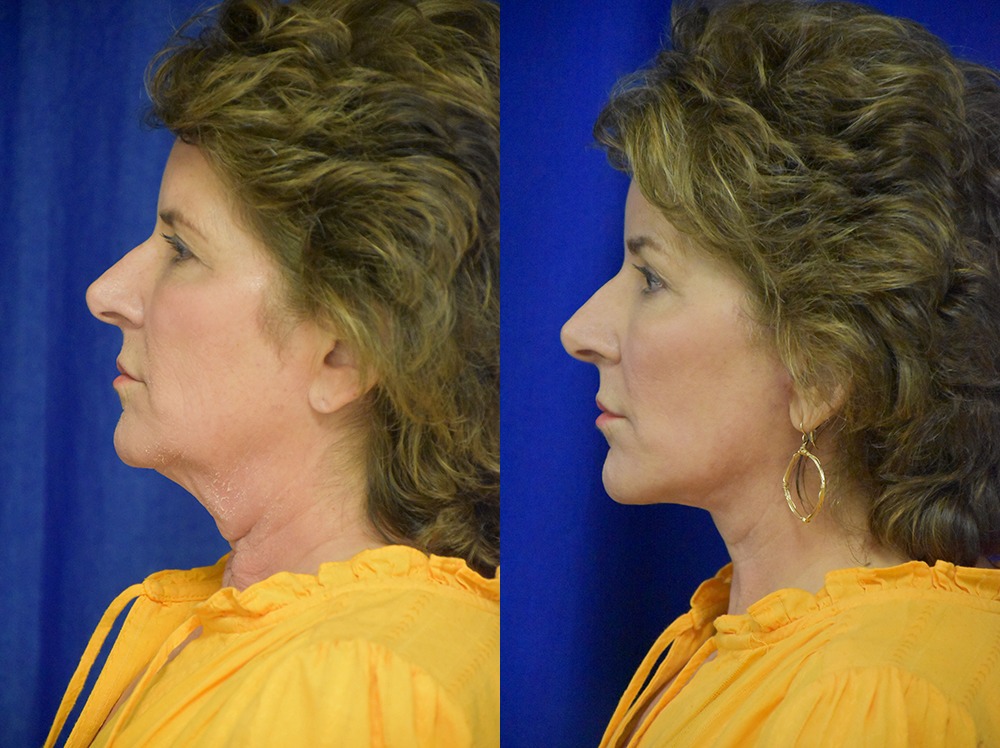 Facelift before and after photo by Dr. Sean Weiss in Metairie LA