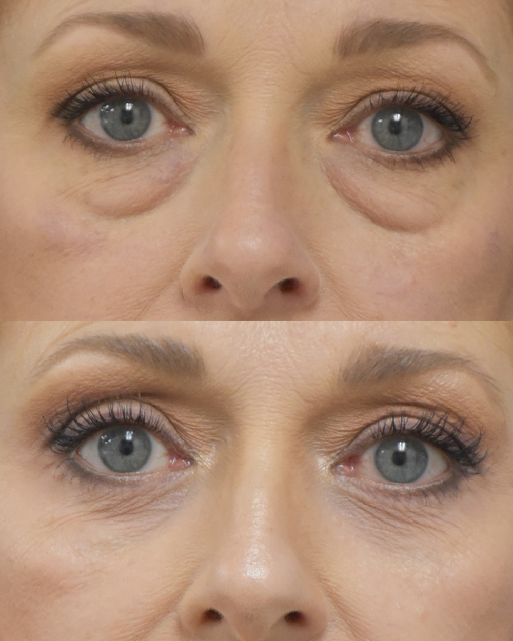 Lower Blepharoplasty before and after photo by Dr. Sean Weiss in Metairie LA