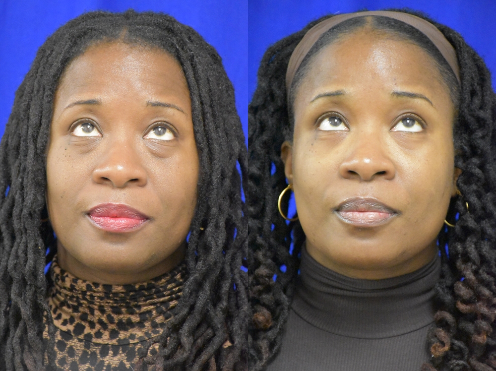 Lower Blepharoplasty with fat transposition before and after photo by Dr. Sean Weiss in Metairie LA